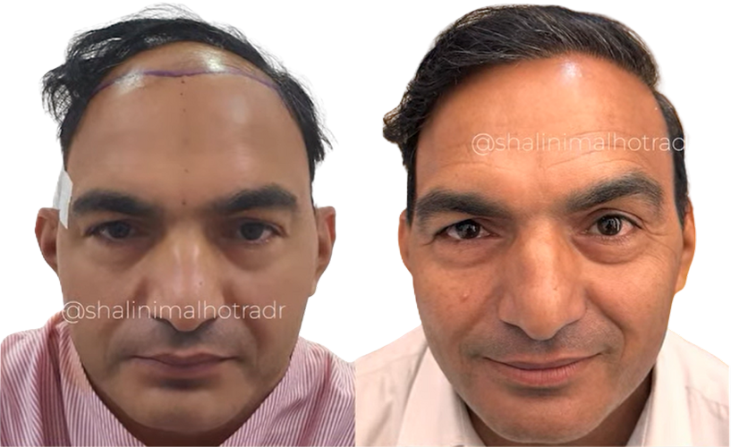 Hairline Transformation new 01