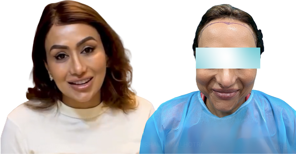Hairline Transformation new